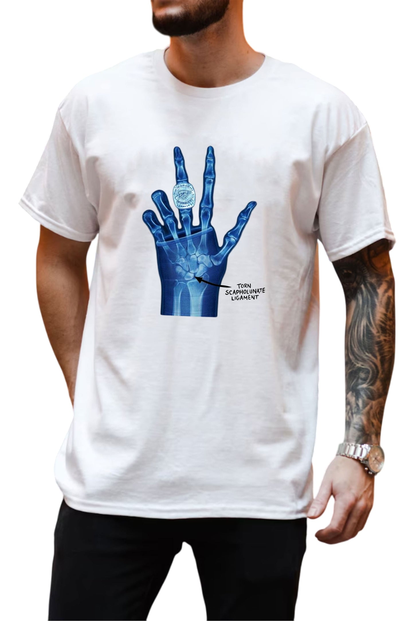Ring Torn Scapholunate Ligament Shirt1